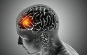 تمدد الأوعية الدموية الدماغية: دليل شامل للمرضى في الإمارات