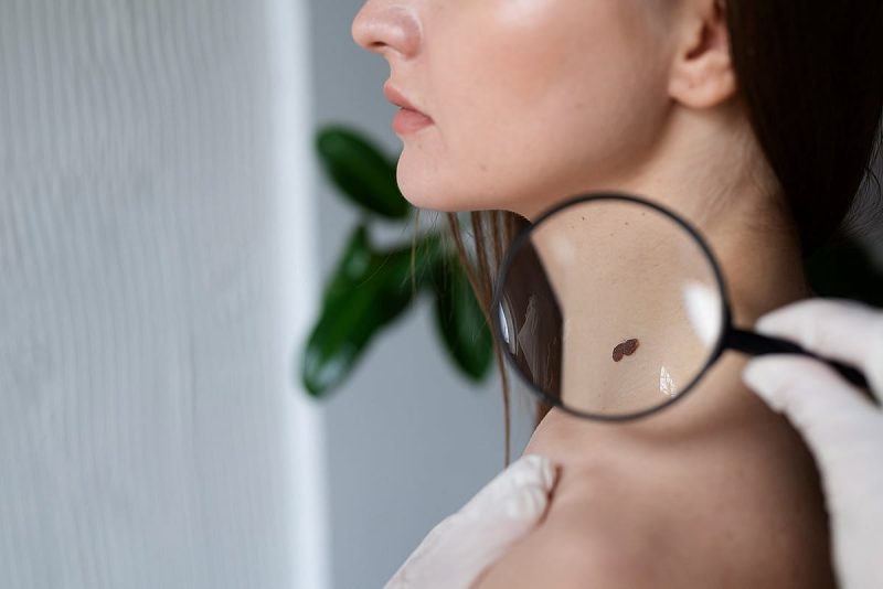 الوقاية أولاً: فحوصات سرطان الجلد في الإمارات تنقذ حياتك