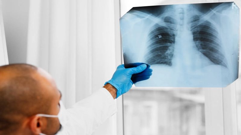 تقليل خطر سرطان الرئة: هل الابتعاد عن الأطعمة المصنعة كاف؟