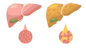 مستقبل علاج تلف الكبد: نظرة على مركب YM81