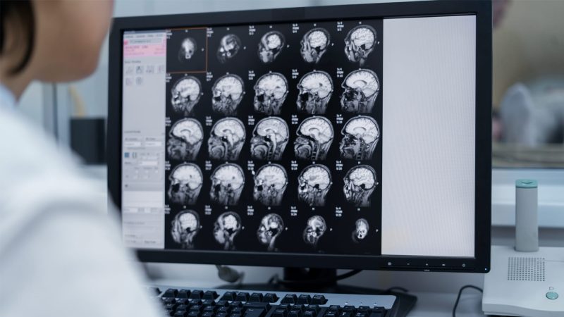 اكتشافات روسية واعدة في مجال علاج الصرع