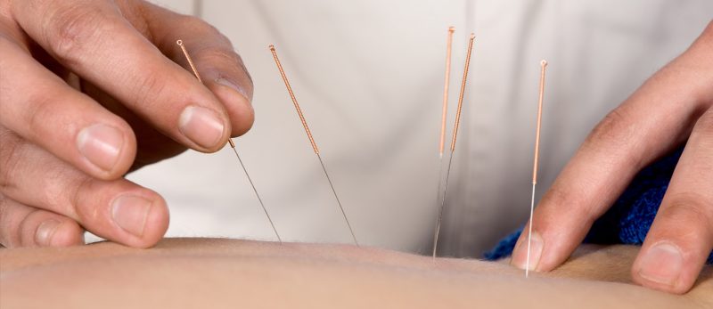 العلاج بالإبر الصينية: استرخِ وتخلص من الألم في الشارقة