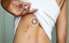 أسرار علاج لدغة بق الفراش الفعال والوقاية من تفشيها