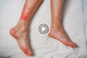 حماية عائلتك: فهم أعراض حساسية بق الفراش والحلول النهائية