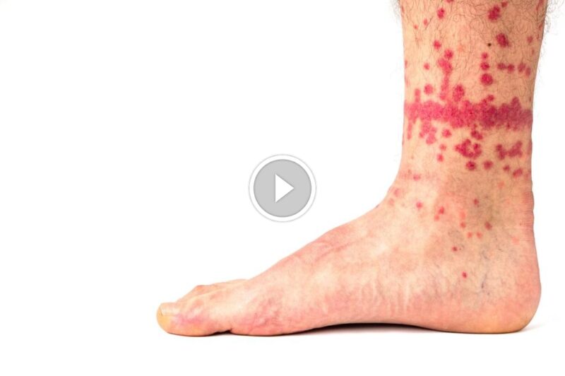 كيف تتخلص من البراغيث؟ دليل شامل للتحكم في الإصابة