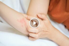 حلول جذرية لمشكلة لدغات بق الفراش المزعجة والمستمرة